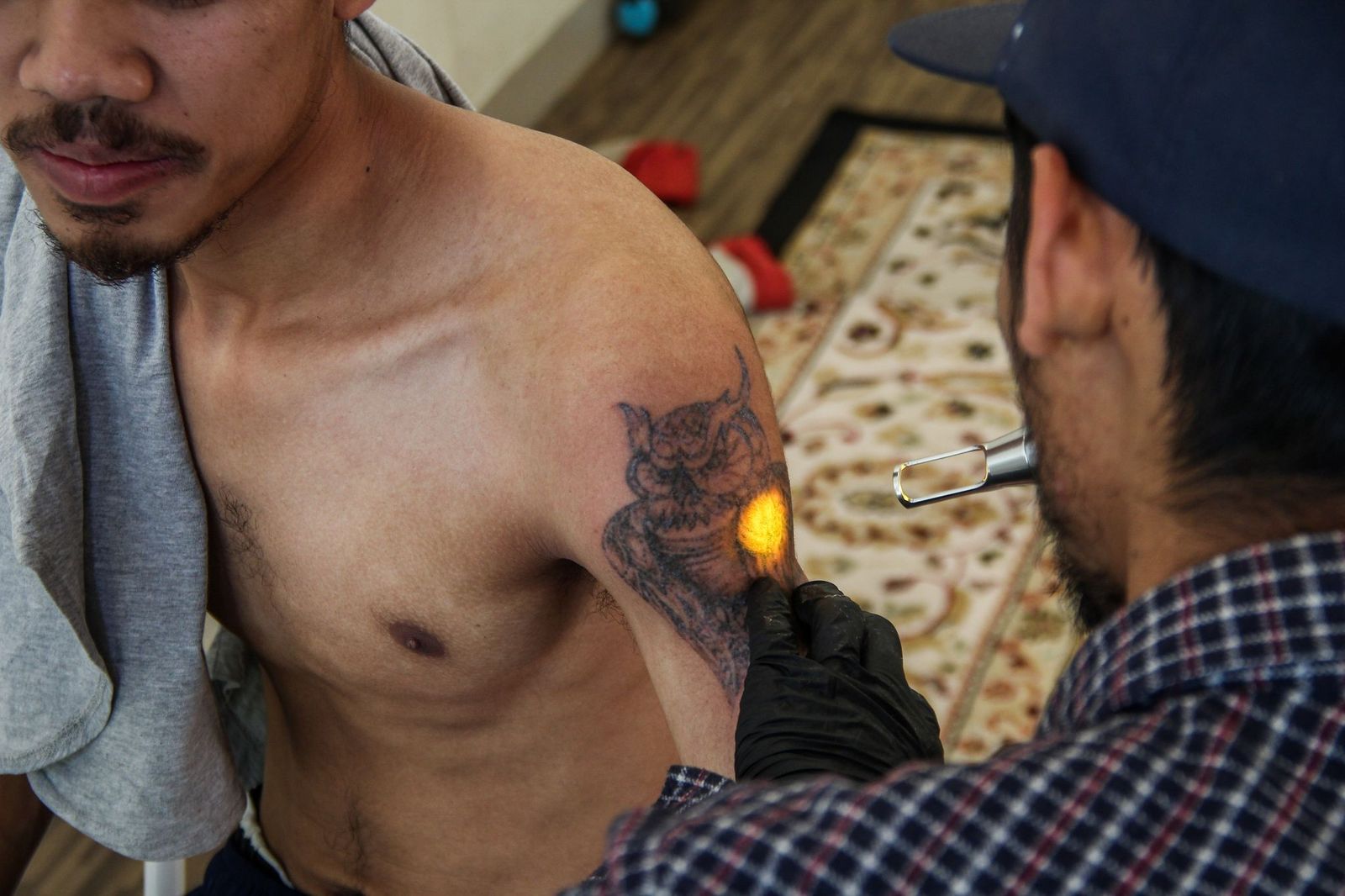 The Rise of Laser Tattoo Removal